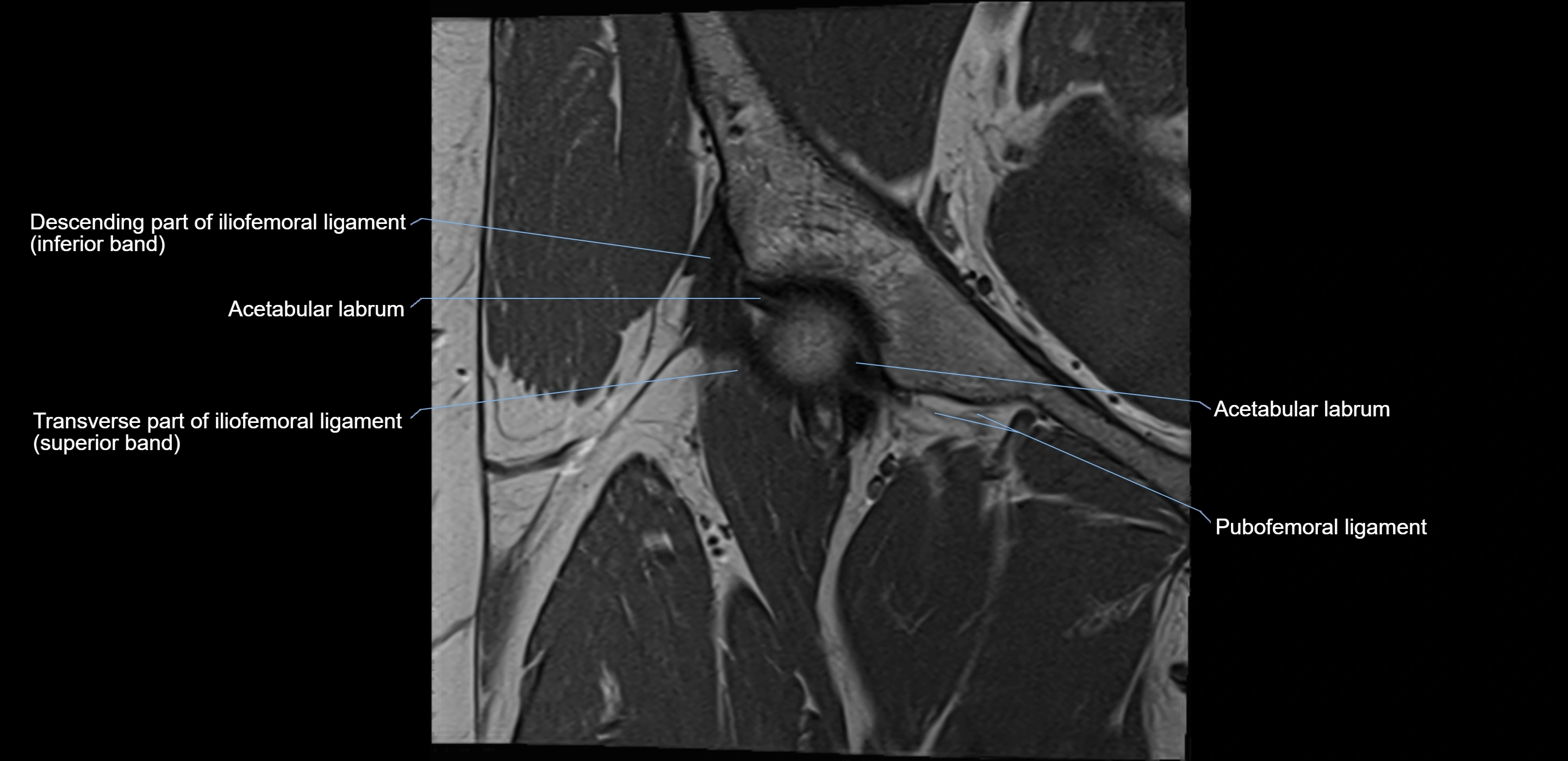 MRI Hip ligaments coronal cross sectional anatomy 3T  radiology  image-img-00001-00004.webp